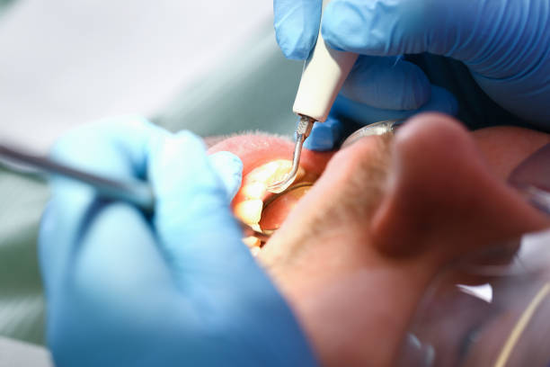 Best Emergency Dental Extractions in Maria Stein, OH