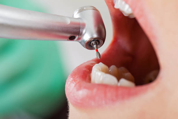 Best Emergency Dental Care for Abscessed Tooth in Maria Stein, OH